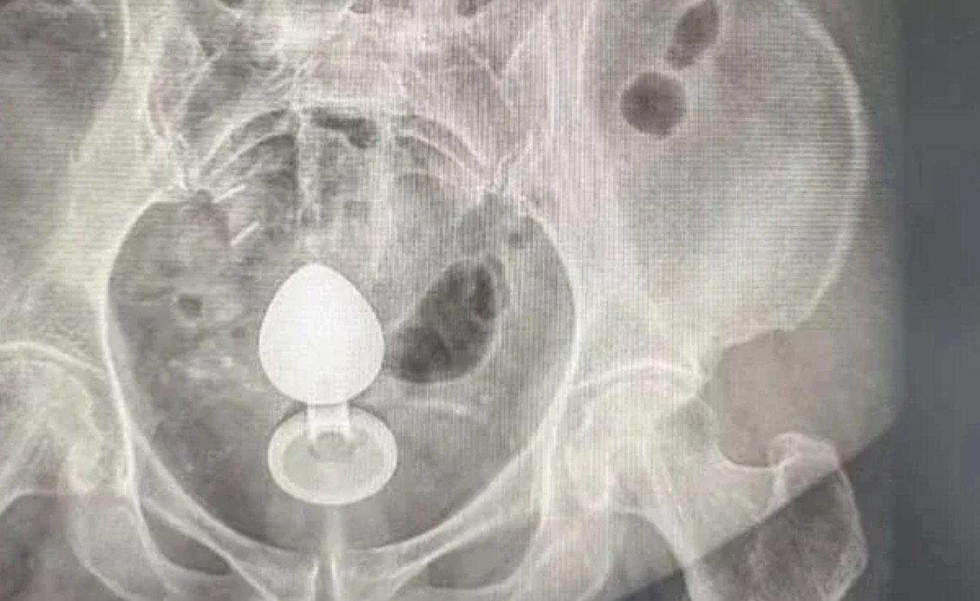 Imagem bizarra foi detectado pelo raio-x (Reprodução)