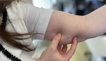 Implante contraceptivo cresce 118% no SUS do Paraná em 2025
