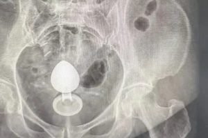 Imagem bizarra foi detectado pelo raio-x (Reprodução)