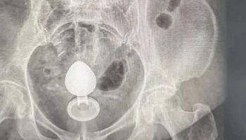 Imagem bizarra foi detectado pelo raio-x (Reprodução)